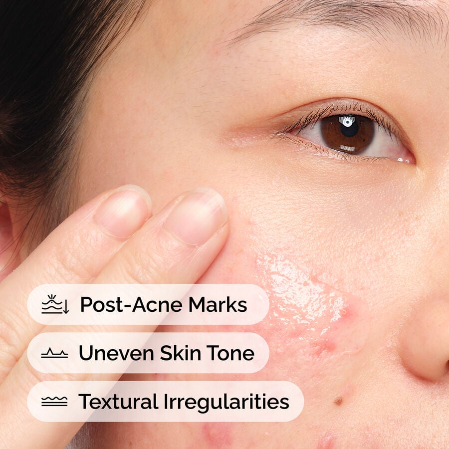 The Ordinary Blemish Solution with Aloe 2% and NAG 2% | Item Overview　Me 3v