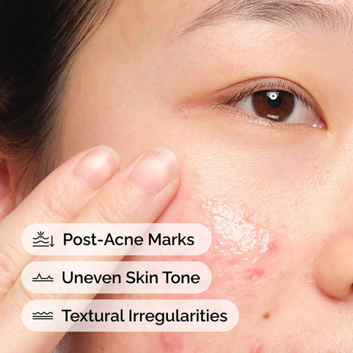 The Ordinary Blemish Solution with Aloe 2% and NAG 2% | Item Overview　Me 3v