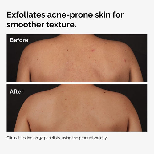 The Ordinary Body Care Treatment - Salicylic Acid 0.5% Body Serum | Product Features　3h 5g